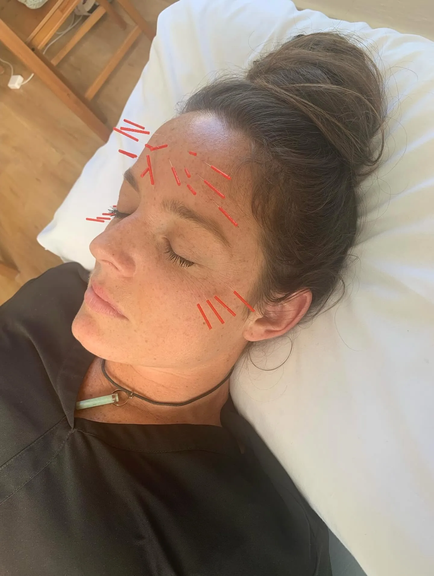 Cosmetic facial acupuncture treatment — red-tipped needles across a client's forehead