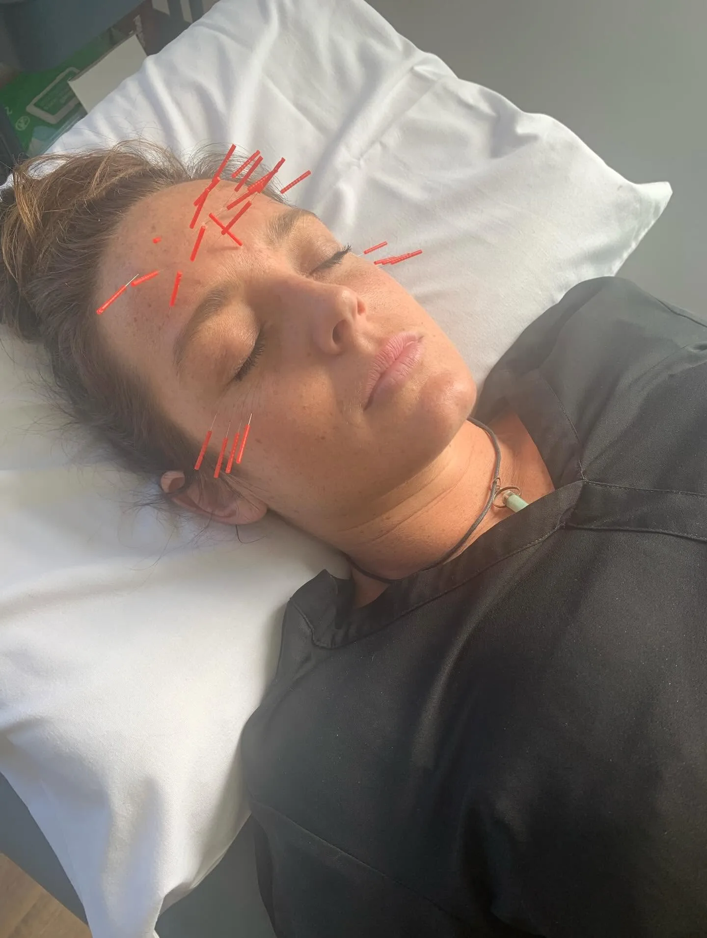 Facial acupuncture close-up during a Chinese medicine session at the clinic